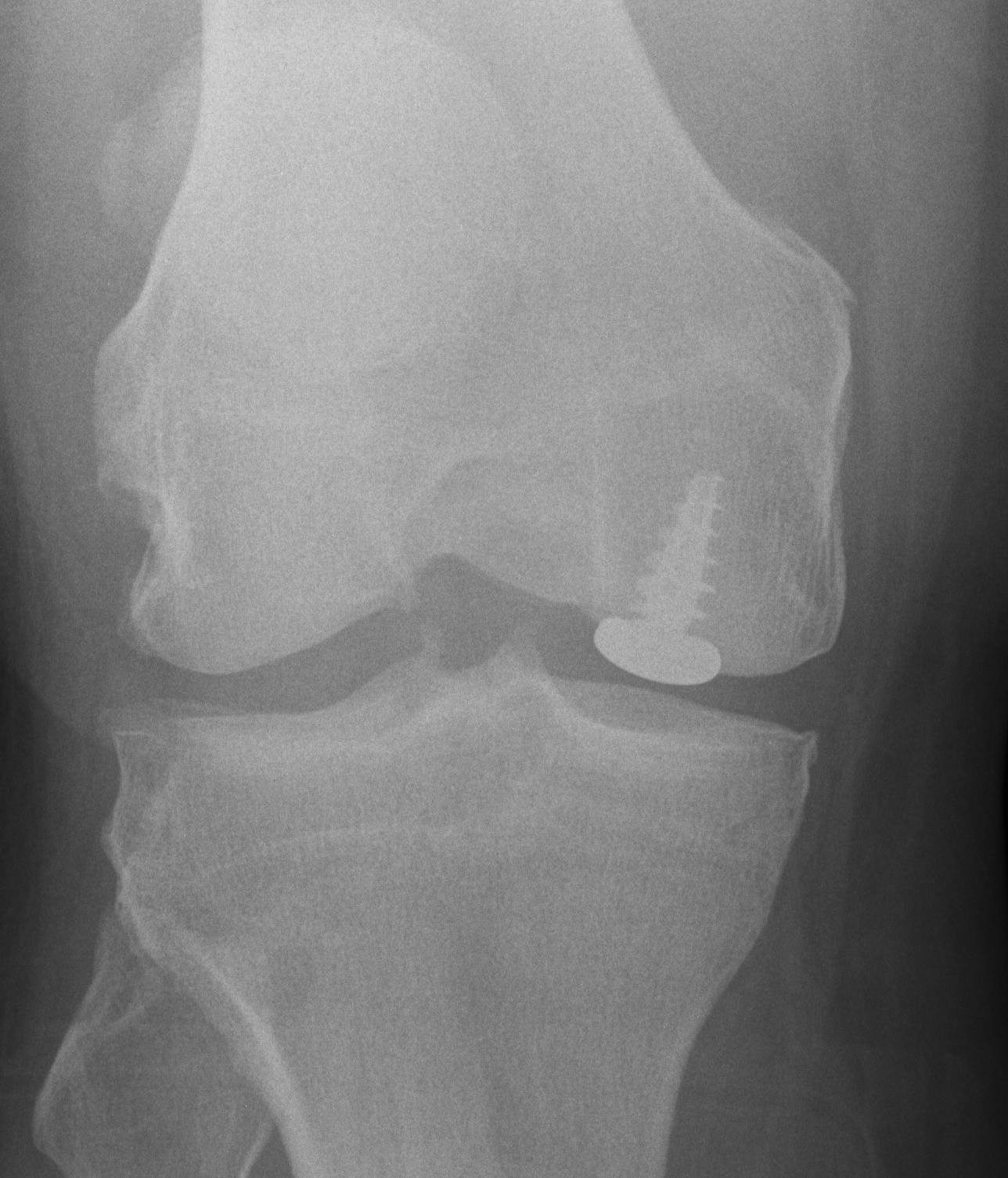 Knee Hemicap AP Post OCD